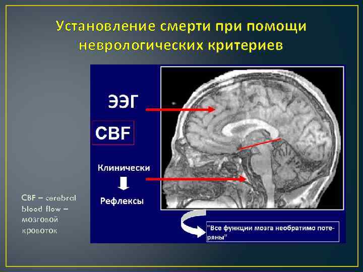 Установление смерти при помощи неврологических критериев CBF – cerebral blood flow – мозговой кровоток