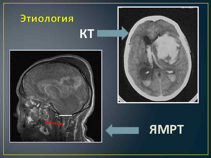 Этиология КТ ЯМРТ 