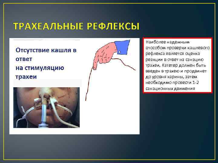 ТРАХЕАЛЬНЫЕ РЕФЛЕКСЫ Наиболее надежным способом проверки кашлевого рефлекса является оценка реакции в ответ на