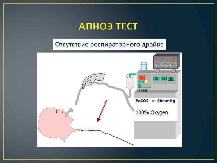 АПНОЭ ТЕСТ Отсутствие респираторного драйва 