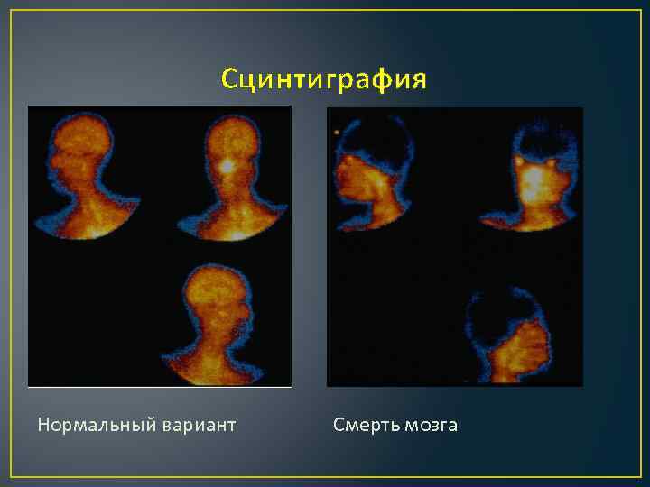 Сцинтиграфия Нормальный вариант Смерть мозга 