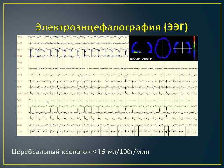 Электроэнцефалография (ЭЭГ) Церебральный кровоток <15 мл/100 г/мин 