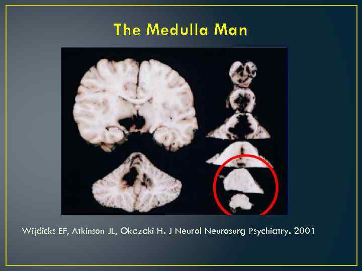 The Medulla Man Wijdicks EF, Atkinson JL, Okazaki H. J Neurol Neurosurg Psychiatry. 2001