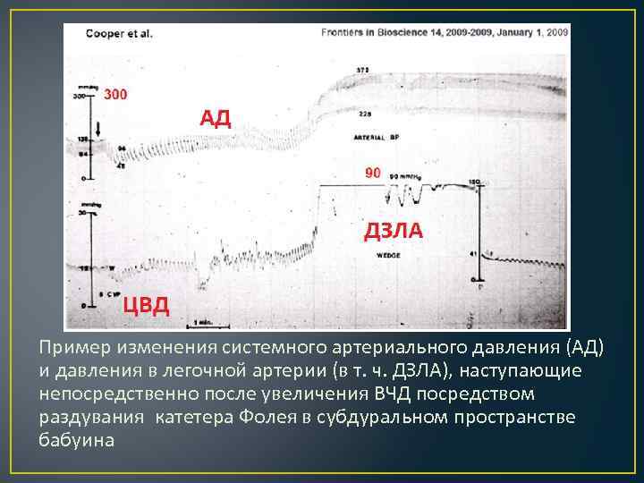 Пример изменения системного артериального давления (АД) и давления в легочной артерии (в т. ч.