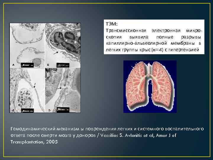 ТЭМ: Трансмиссионная электронная микроскопия выявила полные разрывы капиллярно-альвеолярной мембраны в легких группы крыс (n=4)