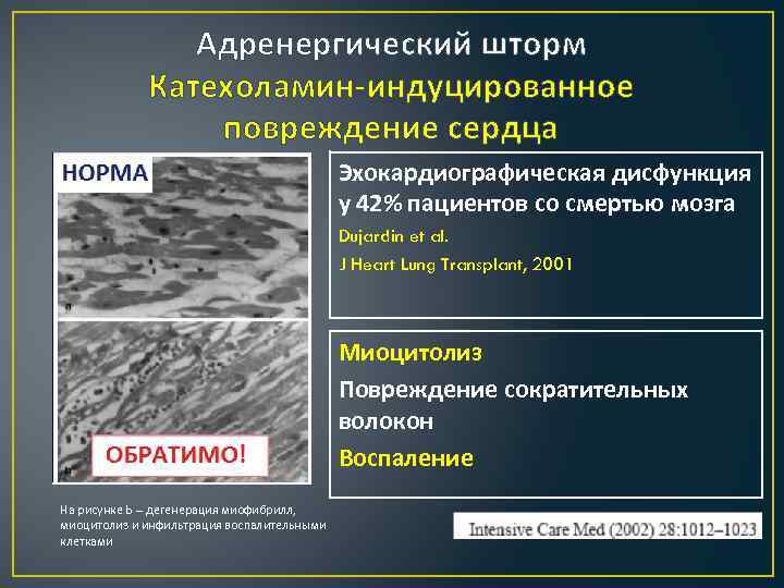 Адренергический шторм Катехоламин-индуцированное повреждение сердца Эхокардиографическая дисфункция у 42% пациентов со смертью мозга Dujardin