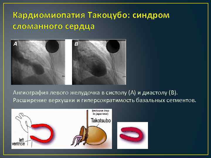 Кардиомиопатия Такоцубо: синдром сломанного сердца Ангиография левого желудочка в систолу (А) и диастолу (В).