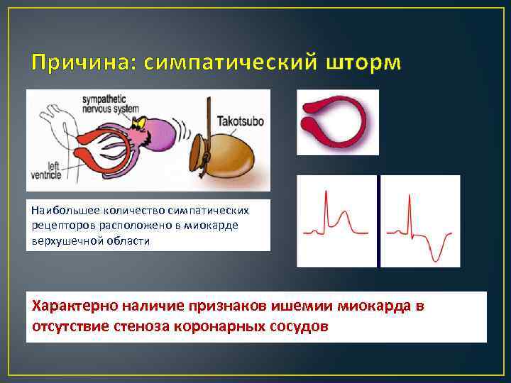 Причина: симпатический шторм Наибольшее количество симпатических рецепторов расположено в миокарде верхушечной области Характерно наличие