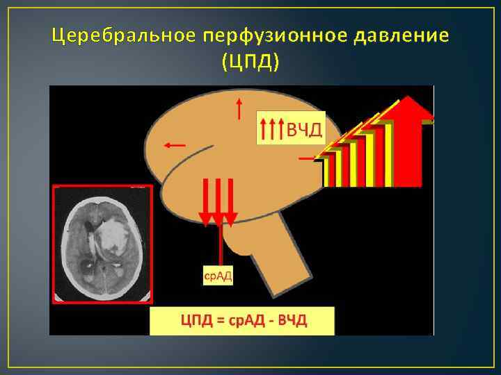 Церебральное перфузионное давление (ЦПД) 