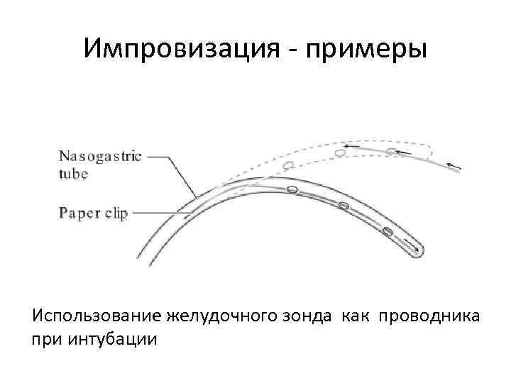 Импровизация - примеры Использование желудочного зонда как проводника при интубации 