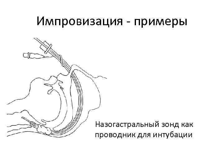 Импровизация - примеры Назогастральный зонд как проводник для интубации 