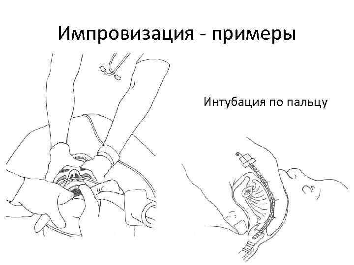 Импровизация - примеры Интубация по пальцу 