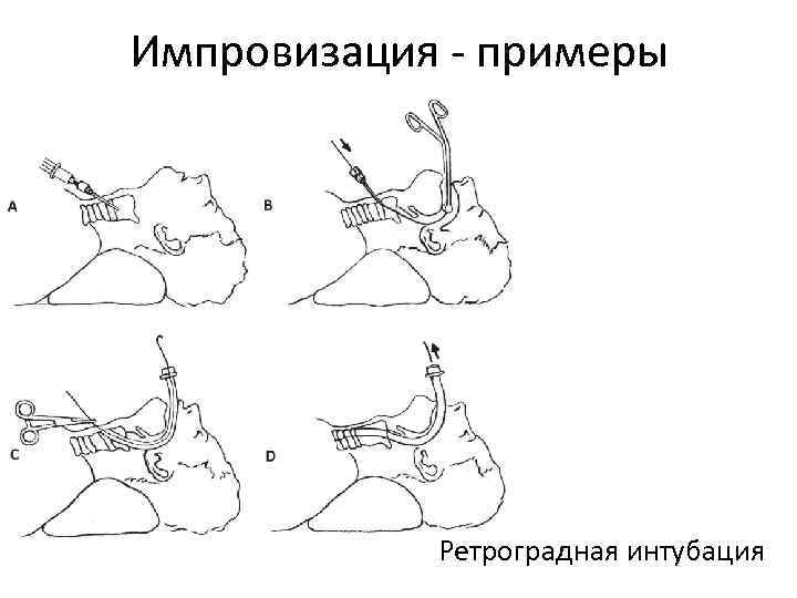 Импровизация - примеры Ретроградная интубация 