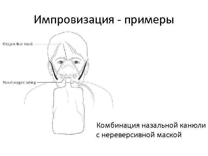 Импровизация - примеры Комбинация назальной канюли с нереверсивной маской 