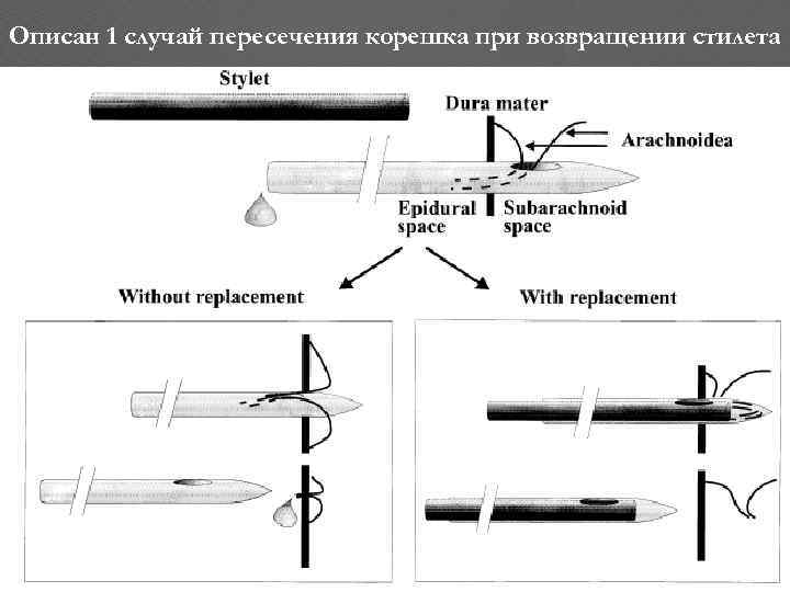 Описан 1 случай пересечения корешка при возвращении стилета 