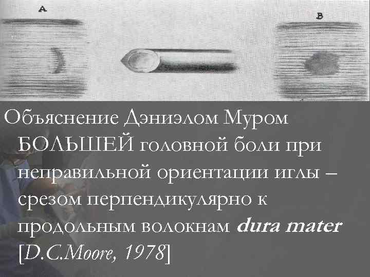 Объяснение Дэниэлом Муром БОЛЬШЕЙ головной боли при неправильной ориентации иглы – срезом перпендикулярно к