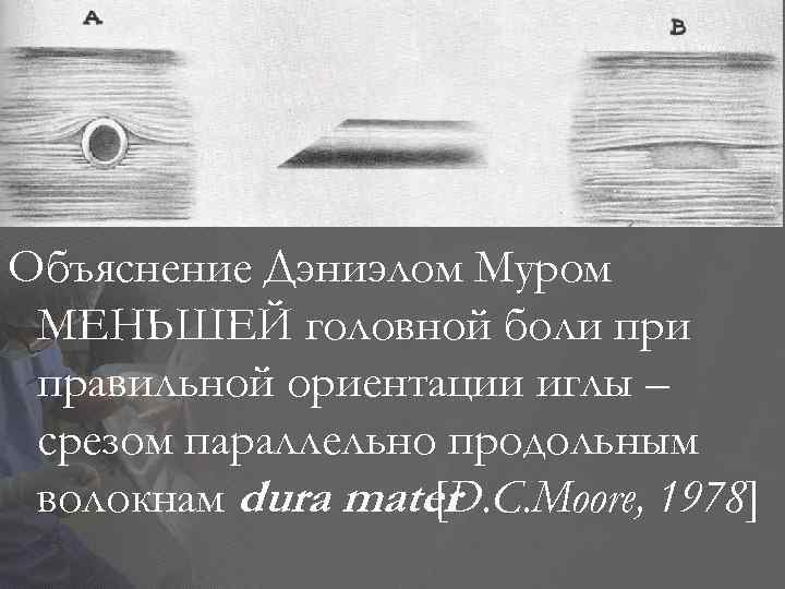 Объяснение Дэниэлом Муром МЕНЬШЕЙ головной боли правильной ориентации иглы – срезом параллельно продольным волокнам