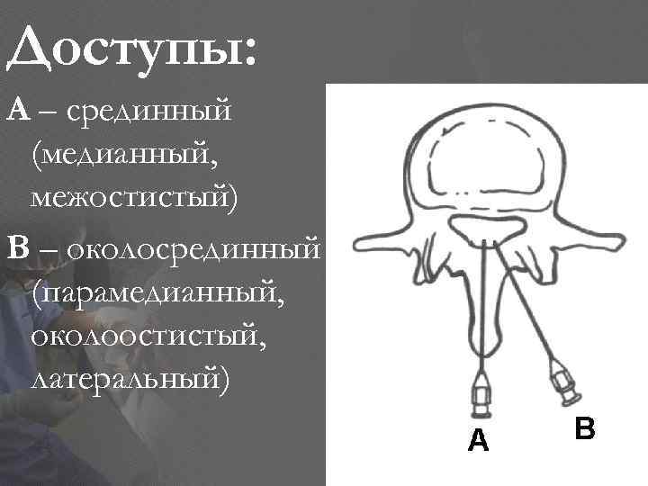 Доступы: А – срединный (медианный, межостистый) В – околосрединный (парамедианный, околоостистый, латеральный) 