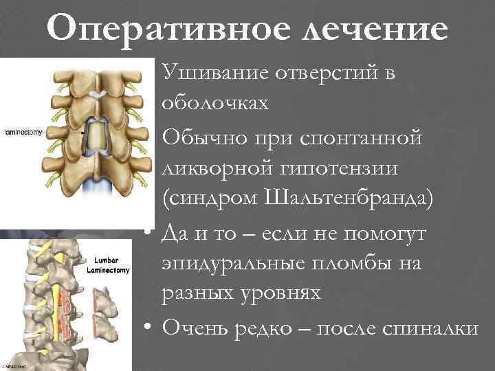 Оперативное лечение • Ушивание отверстий в оболочках • Обычно при спонтанной ликворной гипотензии (синдром