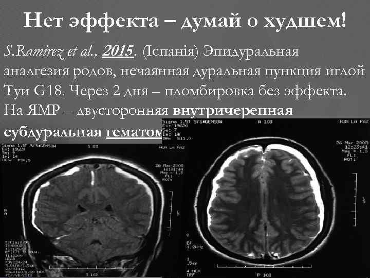 Нет эффекта – думай о худшем! S. Ramírez et al. , 2015. (Іспанія) Эпидуральная