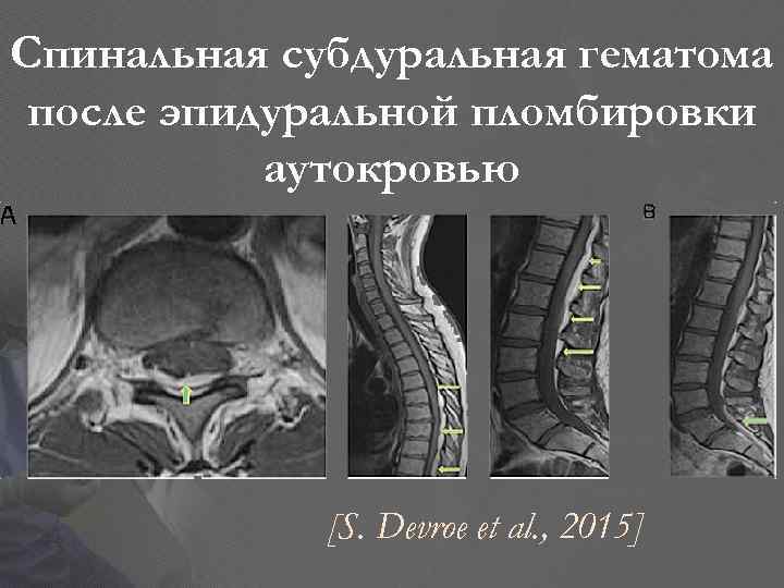 Спинальная субдуральная гематома после эпидуральной пломбировки аутокровью [S. Devroe et al. , 2015] 