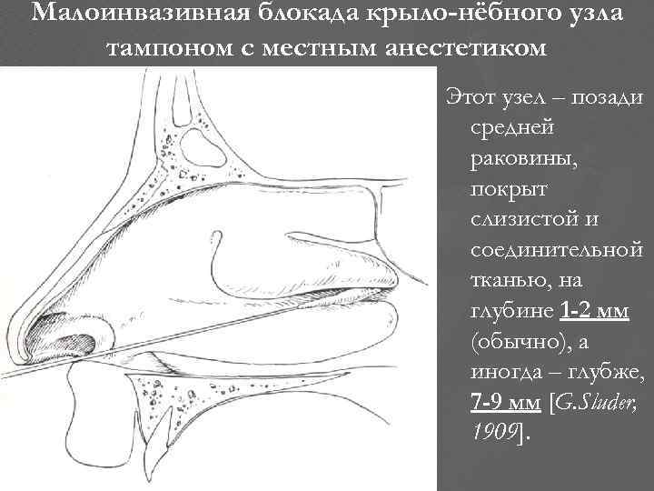 Малоинвазивная блокада крыло-нёбного узла тампоном с местным анестетиком Этот узел – позади средней раковины,