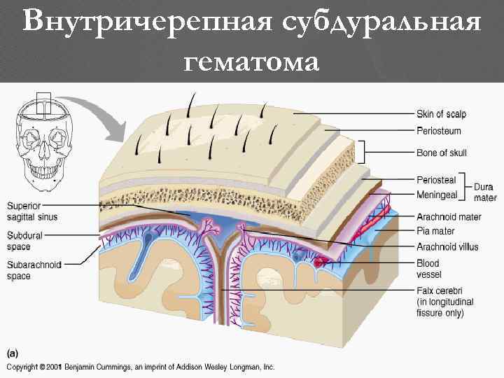 Внутричерепная субдуральная гематома 