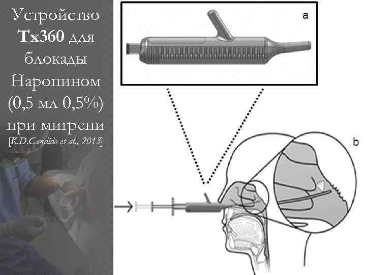 Устройство Tx 360 для блокады Наропином (0, 5 мл 0, 5%) при мигрени [K.