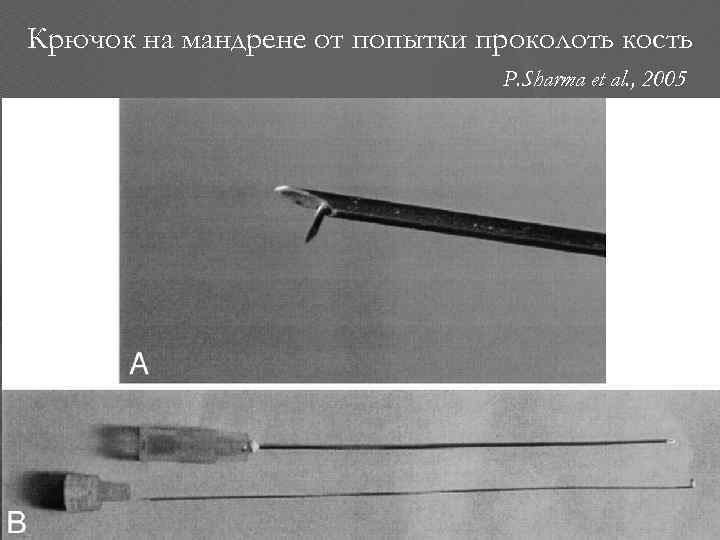 Крючок на мандрене от попытки проколоть кость P. Sharma et al. , 2005 