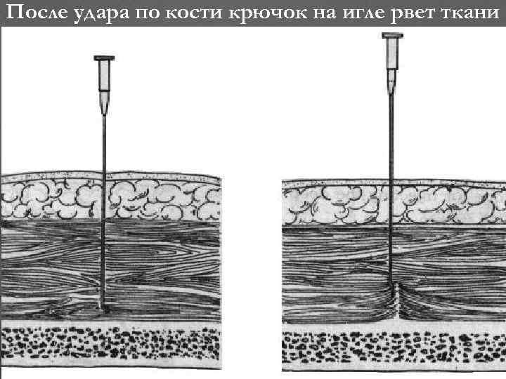 После удара по кости крючок на игле рвет ткани 