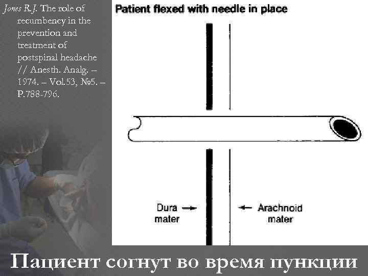 Jones R. J. The role of recumbency in the prevention and treatment of postspinal