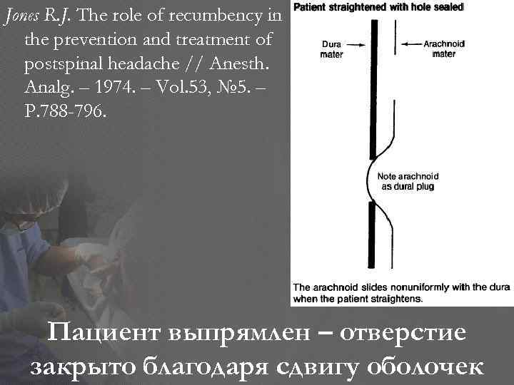 Jones R. J. The role of recumbency in the prevention and treatment of postspinal