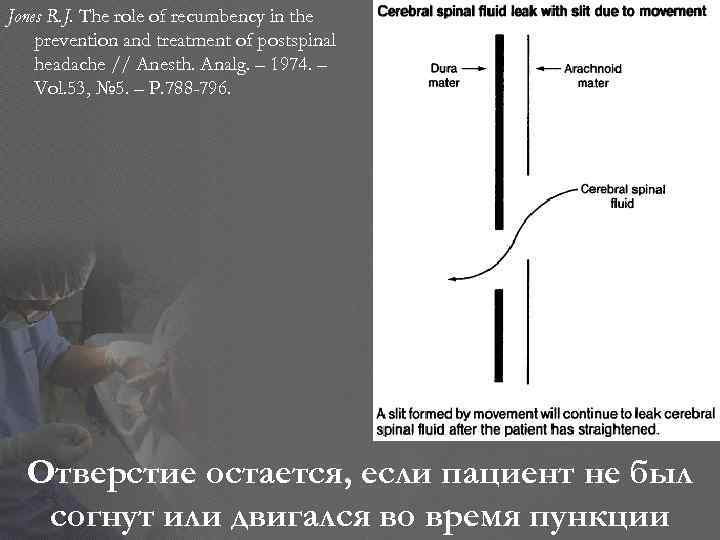 Jones R. J. The role of recumbency in the prevention and treatment of postspinal