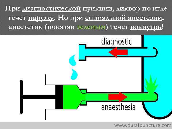 При диагностической пункции, ликвор по игле течет наружу. Но при спинальной анестезии, анестетик (показан