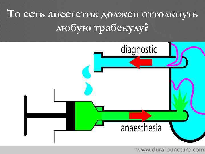 То есть анестетик должен оттолкнуть любую трабекулу? 