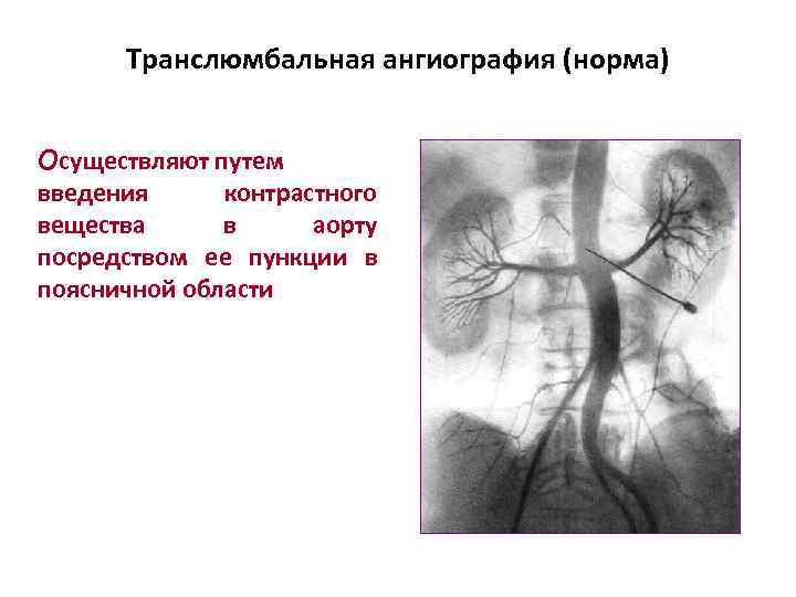 Почечная ангиография презентация