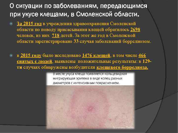 О ситуации по заболеваниям, передающимся при укусе клещами, в Смоленской области. За 2015 год
