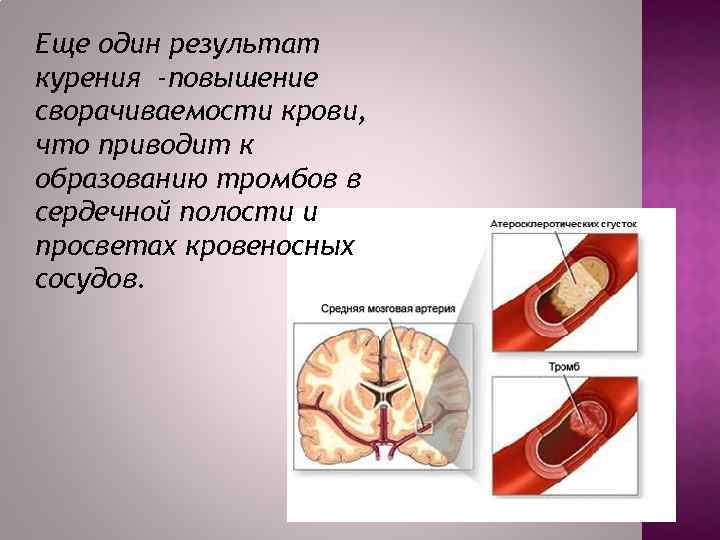 Еще один результат курения -повышение сворачиваемости крови, что приводит к образованию тромбов в сердечной