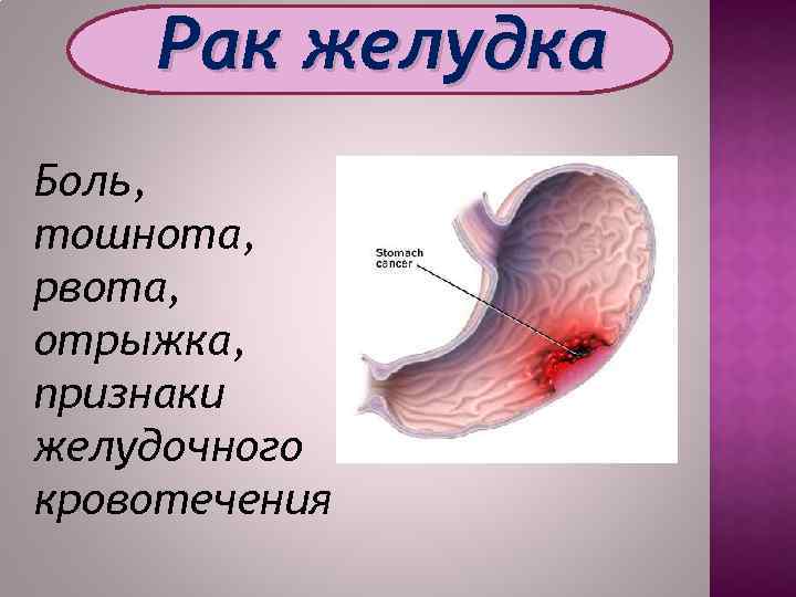 Рак желудка Боль, тошнота, рвота, отрыжка, признаки желудочного кровотечения 