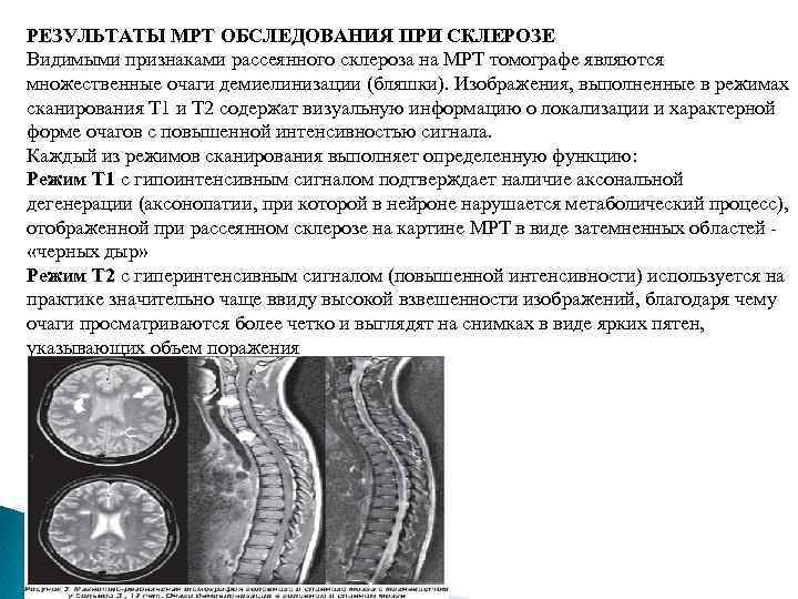 РЕЗУЛЬТАТЫ МРТ ОБСЛЕДОВАНИЯ ПРИ СКЛЕРОЗЕ Видимыми признаками рассеянного склероза на МРТ томографе являются множественные