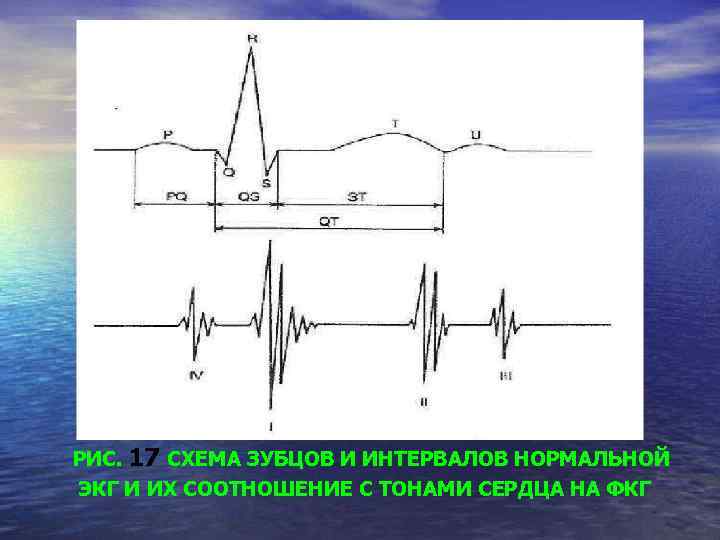РИС. 17 СХЕМА ЗУБЦОВ И ИНТЕРВАЛОВ НОРМАЛЬНОЙ ЭКГ И ИХ СООТНОШЕНИЕ С ТОНАМИ СЕРДЦА