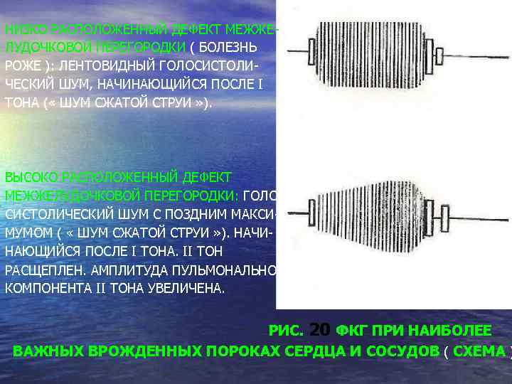НИЗКО РАСПОЛОЖЕННЫЙ ДЕФЕКТ МЕЖЖЕЛУДОЧКОВОЙ ПЕРЕГОРОДКИ ( БОЛЕЗНЬ РОЖЕ ): ЛЕНТОВИДНЫЙ ГОЛОСИСТОЛИЧЕСКИЙ ШУМ, НАЧИНАЮЩИЙСЯ ПОСЛЕ