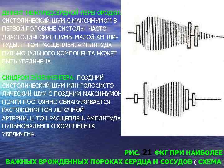 Дмпп аускультативная картина