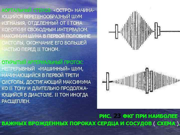 АОРТАЛЬНЫЙ СТЕНОЗ: «ОСТРО» НАЧИНАЮЩИЙСЯ ВЕРЕТЕНООБРАЗНЫЙ ШУМ ИЗГНАНИЯ, ОТДЕЛЕННЫЙ ОТ I ТОНА КОРОТКИМ СВОБОДНЫМ ИНТЕРВАЛОМ.