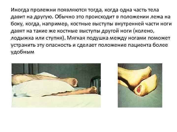 Иногда пролежни появляются тогда, когда одна часть тела давит на другую. Обычно это происходит