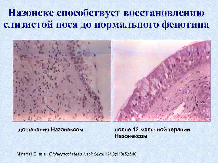 Назонекс способствует восстановлению слизистой носа до нормального фенотипа до лечения Назонексом после 12 -месячной