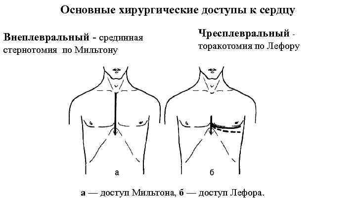 Основные хирургические доступы к сердцу Внеплевральный - срединная стернотомия по Мильтону Чресплевральный - торакотомия