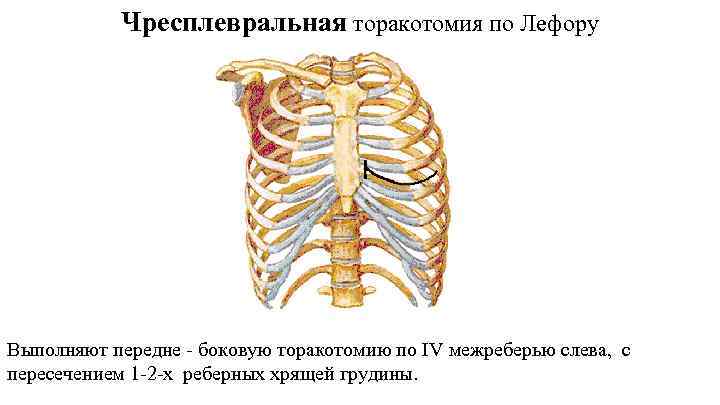 Чресплевральная торакотомия по Лефору Выполняют передне - боковую торакотомию по IV межреберью слева, с