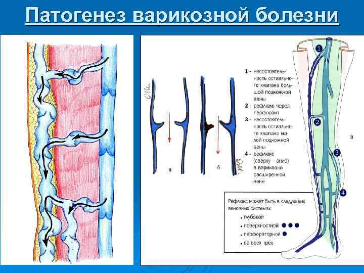 Патогенез варикозной болезни 