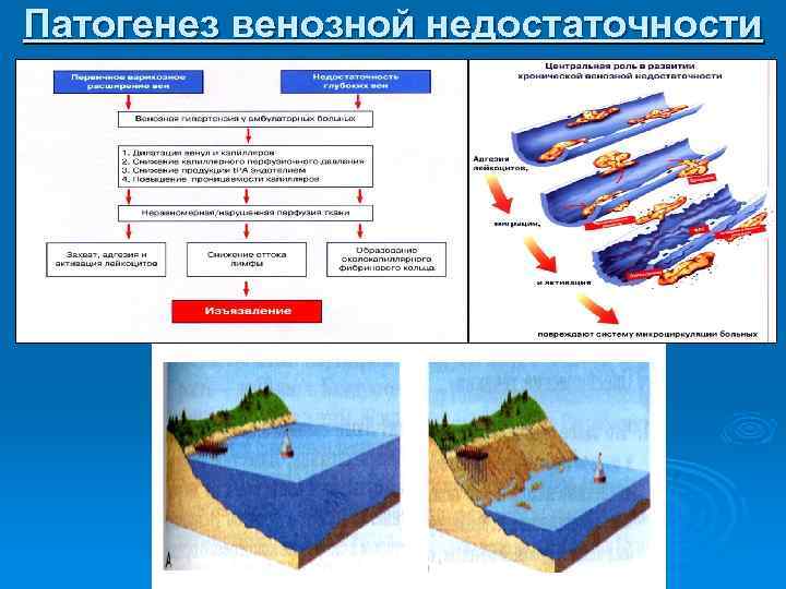 Патогенез венозной недостаточности 